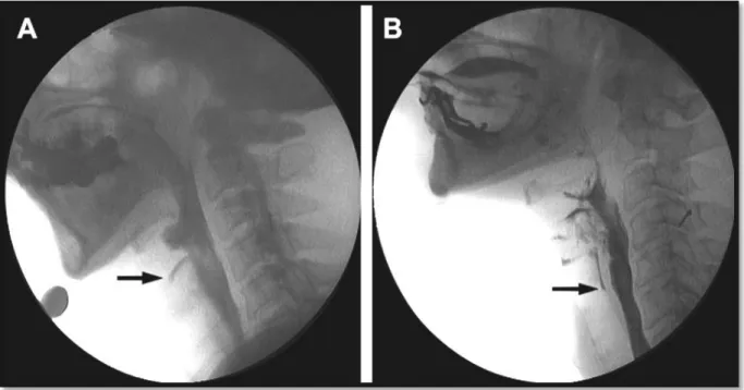 Figure 9: Vidéo fluoroscopie de la déglutition. Pénétration laryngée (A) Inhalation (B)