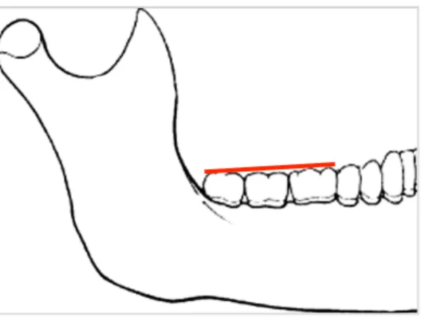 Figure 4:  Alignement de la troisième molaire avec le plan occlusal 