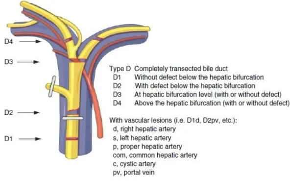 Figure I.5 : Lésion type E (sténose) de la Classification « de Hanovre » (21) 