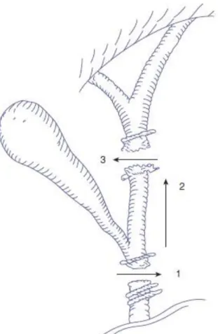 Figure I.10 : Physiopathologie de la plaie biliaire et artérielle « classique »  (49) 