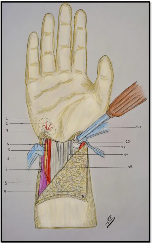 Figure 6 : création du foyer de pseudarthrose expérimental au sein du scaphoïde a l’aide d’un ostéotome