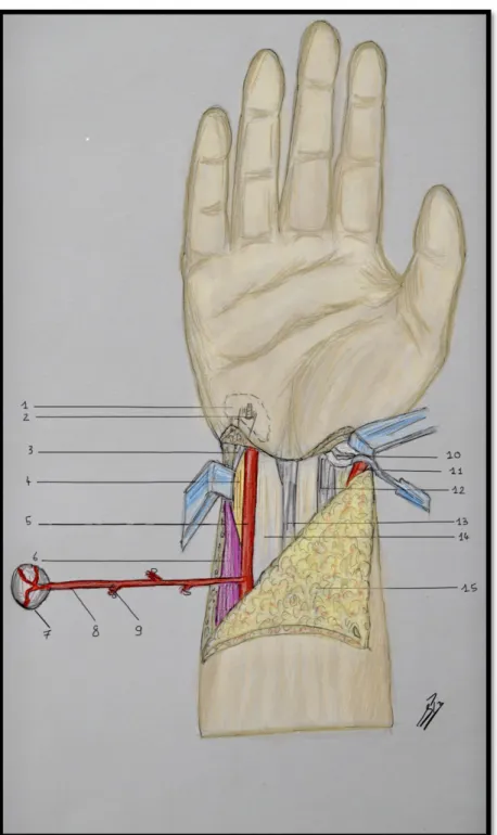 Figure 7 : Libération progressive du pédicule du pisiforme par ligature des branches collatérales de l’artere dorso- dorso-ulnaire