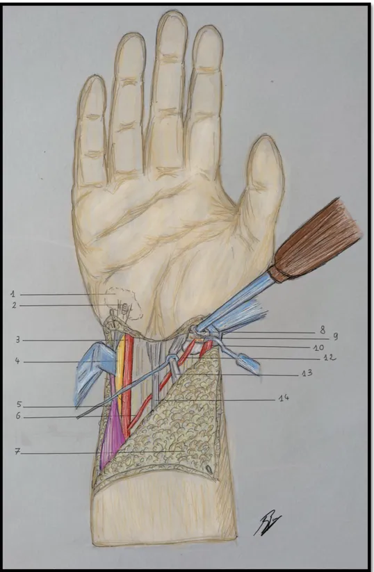 Figure 9 : Vissage en compression du pédicule du pisiforme au sein du scaphoïde par une vis de Herbert canulée