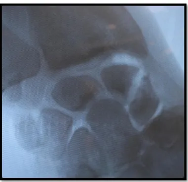 Figure 12 : Radiographie du poignet de face montrant le foyer de pseudarthrose transcoporéal du scaphoïde 
