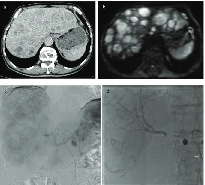 Fig. 1 Imagerie pré thérapeutique par scanner injecté (a) et IRM de diffusion (b 1000) (b)  d’un patient de 76 ans présentant une maladie métastatique avancée, avec un envahissement  hépatique évaluée à plus de 50%