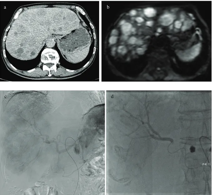 Fig. 1 Pre-TACE enhanced CT (a) and DWI (b 1000) MRI (b) on a 76 years-old male patient  with advanced hepatic metastatic disease evaluated as more than 50% of liver replacement