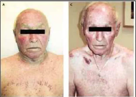 Figure  2  :  Clinic  aspect  of  a  patient  with  Superior  Vena  Cava  Syndrome  before  and  after  Endovascular Treatment 