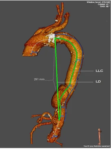 Figure 3. Indice de tortuosité aortique de l’aorte thoracique descendante 