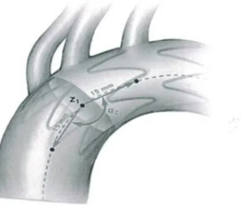 Figure 4. Mesure de l’angulation du collet proximal (méthode Hsu &amp; al.) 