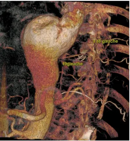 Figure 6. Exemple de reconstruction 3D à partir d’une artériographie médullaire préopératoire  :   (chez ce patient, l’artère médullaire nait de T8 gauche alimentée par T9 gauche et localisée en regard de la zone 