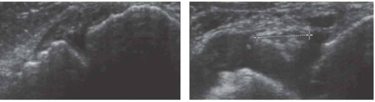 Figure  29.  Images  échographiques  d’une  patiente  de  37  ans  avec  un  conflit  tissulaire  antérolatéral  confirmé par l’arthroscopie, d’après Cochet (57)
