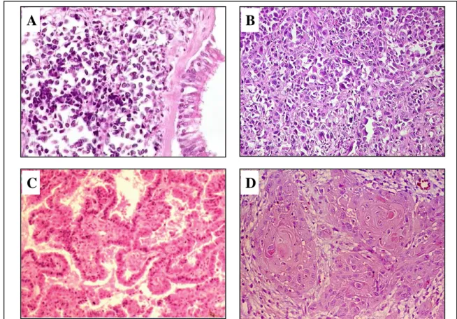 Figure 7 : coloration HES d’un carcinome à petites cellules (A), d’un carcinome à grandes  cellules (B), d’un adénocarcinome papillaire (C) et d’un carcinome épidermoïde (D)