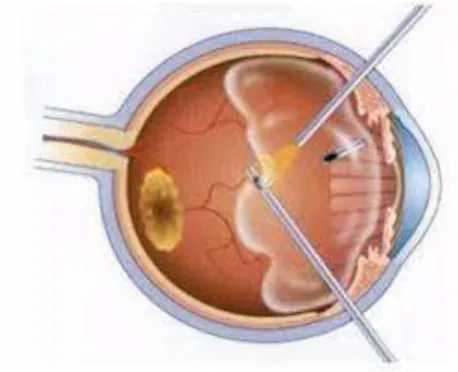 Figure 10: infusion endoculaire, vitréotome et lumière froide pour une vitrectomie à la pars plana  
