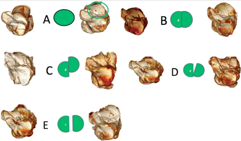 Fig. 3.  Classification des réductions de la facette articulaire postérieure sur la vue antérieure des reconstructions 3D sur TDM selon  Goldzak : Type A : surface intacte, Type B : réduction anatomique, Type C : marche d'escalier, Type D : écart postéro-s