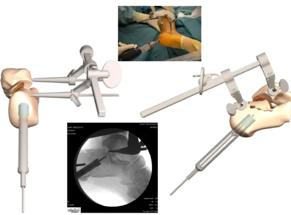 Fig. 7.  Démonstration sur os sec et vue peropératoire de l'autogreffe osseuse cylindrique