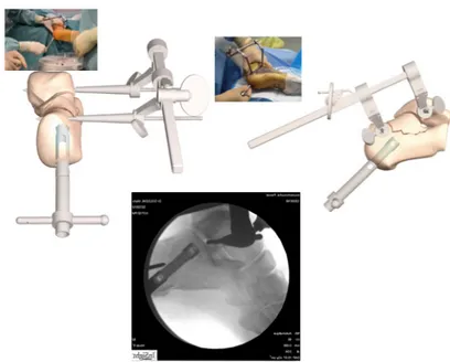 Fig. 10.  Introduction du clou sous la surface thalamique. 