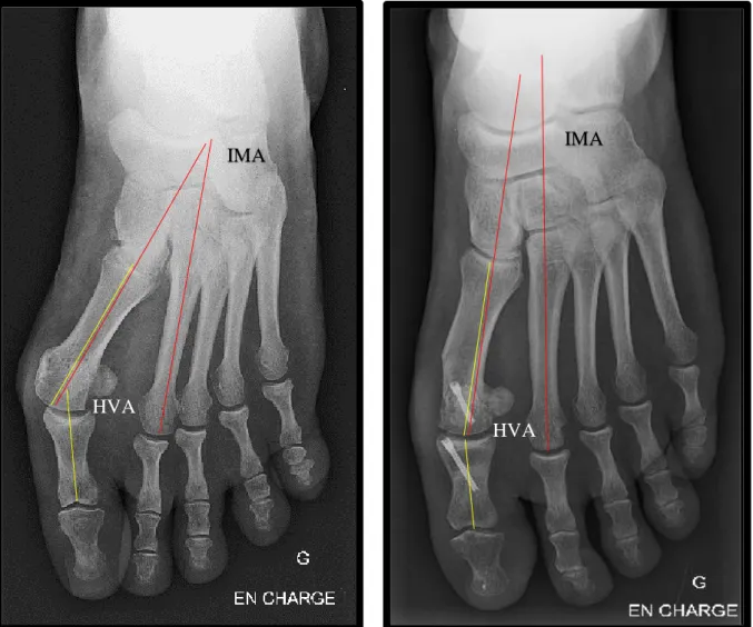 Fig. 14 : radiographies en charge pied face (pré et post opératoire) chez une patiente avec un  hallux valgus isolé (HVA pré opératoire = 38° / IMA pré opératoire = 18° / HVA post opératoire 