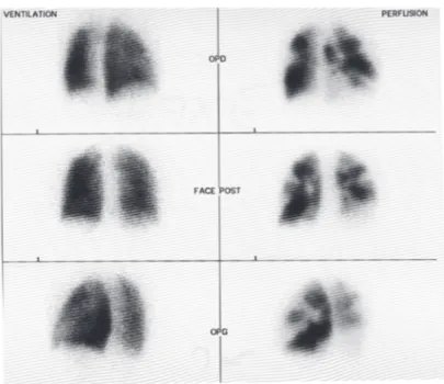Figure 8 : Scintigraphie pulmonaire de ventilation/perfusion  