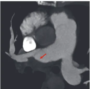 Figure 11: Redistribution vasculaire avec perfusion dit en mosaïque au scanner thoracique.