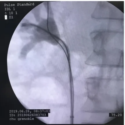Figure 9 : urétéroscope souple avec gaine d’accès, guide de sécurité dans le calice supérieur  et sonde panier dans le calice moyen