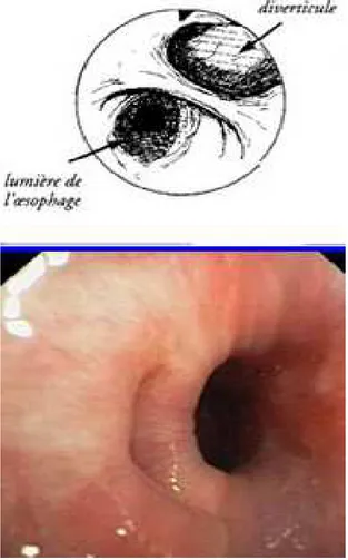 Figure 2 : schéma et vue endoscopique d’un diverticule de Zenker. 