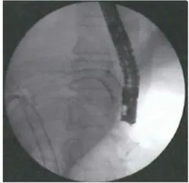 Figure 1 – Hépaticogastrostomie sous écho-endoscopie 