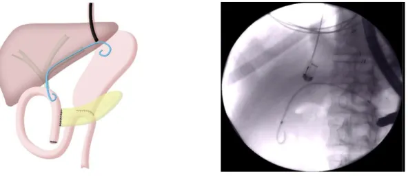 Figure 4 – Cholangioscopie antérograde 