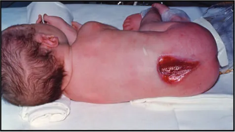 Figure 2 : Nouveau-né présentant une lésion de myéloschisis. 