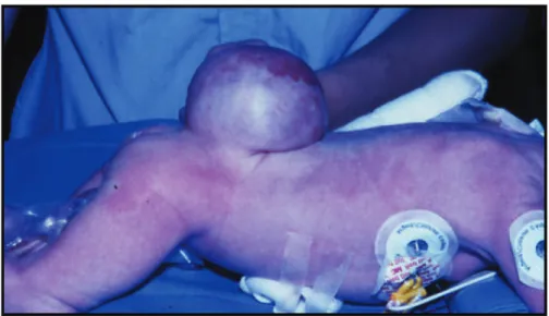 Figure 3 : enfant porteur d’une myéloméningocèle épidermisée. 