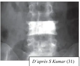 Figure 6 : Radiographie du rachis  lombaire de face 