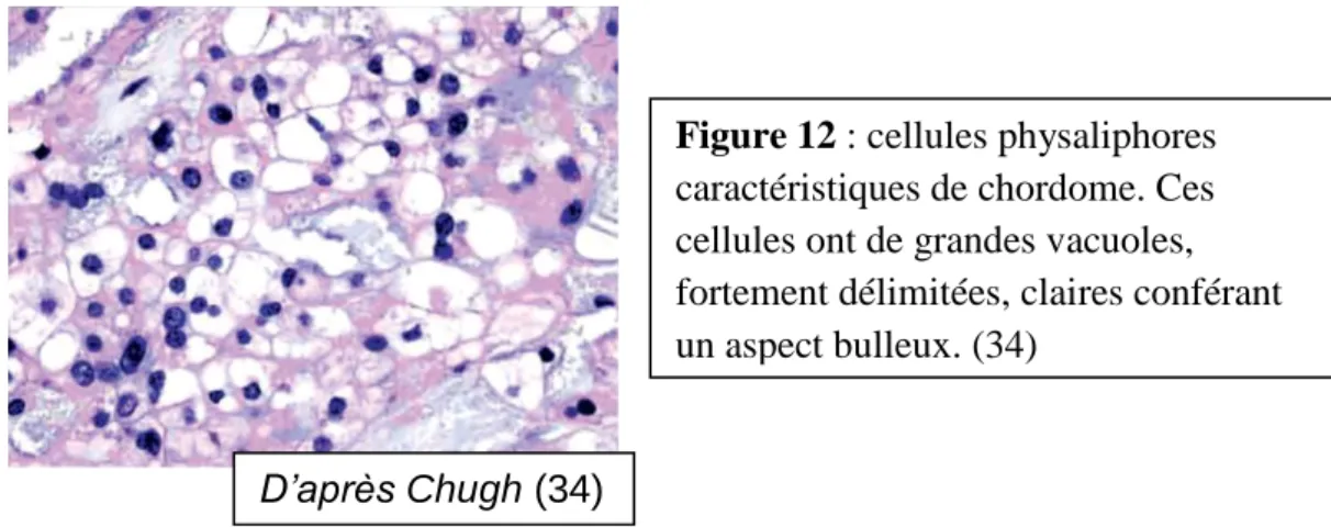 Figure 12 : cellules physaliphores  caractéristiques de chordome. Ces  cellules ont de grandes vacuoles,  fortement délimitées, claires conférant  un aspect bulleux