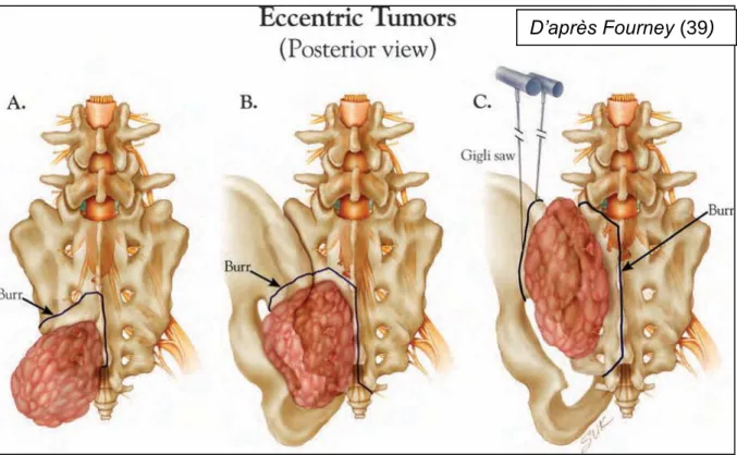 Figure 16 : Tumeurs sacrées excentrées avec atteinte de plus en plus large de l’hémi- l’hémi-sacrum gauche et de l'articulation sacro-iliaque