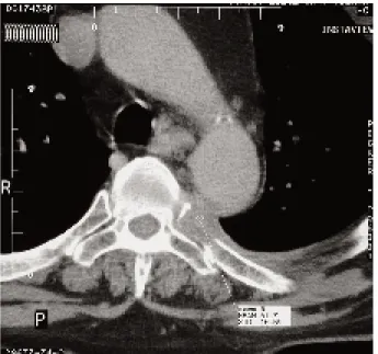 Fig. 1. Exploration tomodensitométrique de la jonction dorsale D5- D5-D6 identifiant un processus expansif responsable de la lyse du col, de la tête et d’une partie du tubercule de la 5 ème côte gauche.