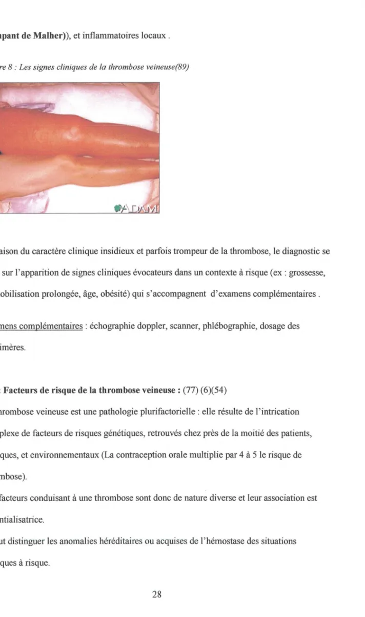 Figure 8 : Les signes cliniques de la thrombose veineuse(89) 