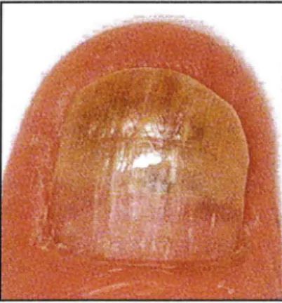 Figure 4 : onychomycose sous-unguéale disto-latérale avec onycholyse d'emblée. 