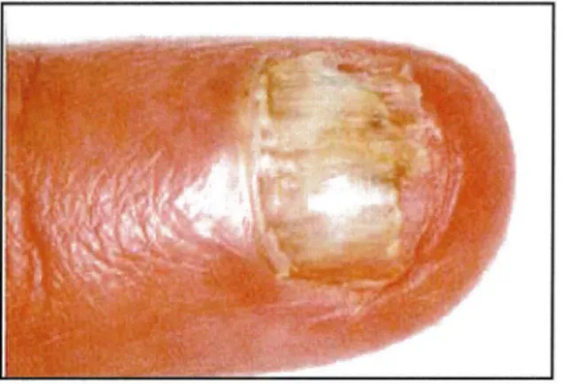 Figure 9 : onychomycose sous-unguéale proximale avec leuconychie et paronychie aiguë à  Fusarium