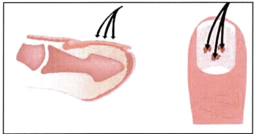 Figure 10 : mode de pénétration des champignons dans une onychomycose de variété superficielle