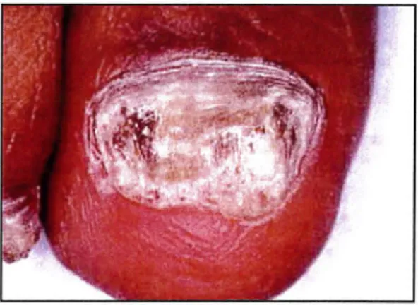 Figure 12  : onychomycose dystrophique totale. 