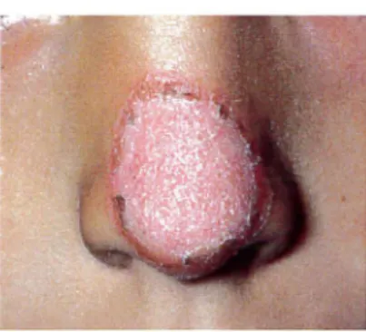 Figure 9. Lésion très inflammatoire à  M  gypseum  (67)  -. 