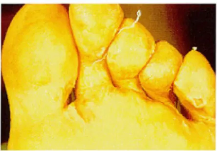 Figure 11.  Pied d'athlète (67) 