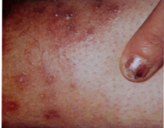 Figure 16. Périfolliculite granulomateuse d'une jambe et onychomycose distale d'un doigt  à T  rubrum