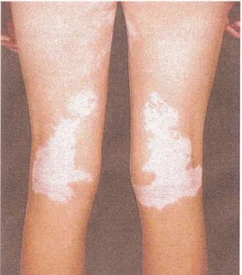 Figure 8:  Distribution symétrique de la dépigmentation dans un vitiligo généralisé,  au niveau des membres inférieurs 