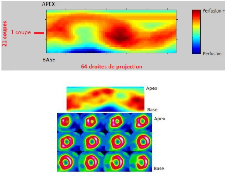 Figure 1: Short axis Thalium 201 MPI SPECT images and 2D myocardial perfusion map 