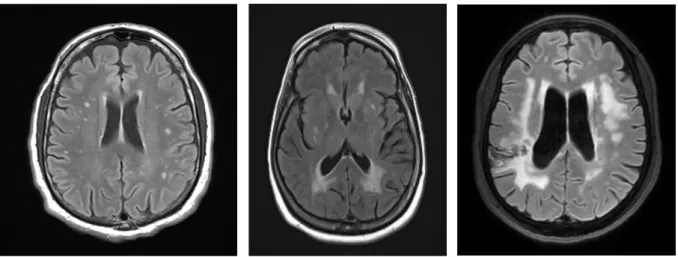 Figure  2:  stage  1  (at  the  left)  to  stage  3  (at  the  right)  of  ARWMC  scale,  on  FLAIR  MRI  acquisition
