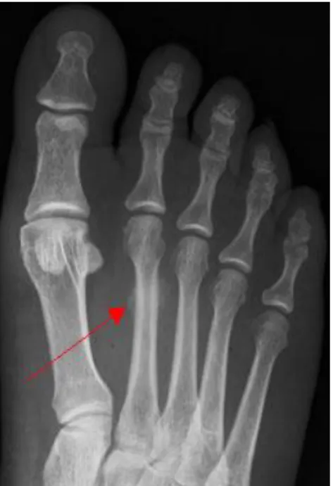 Figure 2 : Cal osseux sur le 2e métatarsien évoquant une fracture de fatigue  Examen réalisé dans les 15 jours suivant la première consultation 