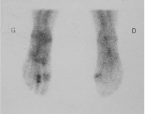 Figure 7 : Hyperfixation en regard 2e métatarsien pied gauche évoquant  une fracture de fatigue 