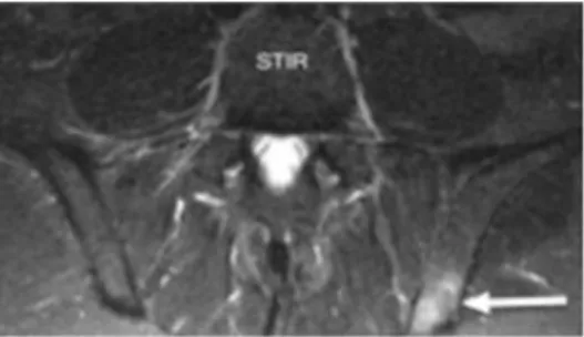 Figure 10. IRM des articulations sacro-iliaques en pondération T1 (gauche) et STIR  (droite) : œdème osseux bilatéral (Source : EULAR) 