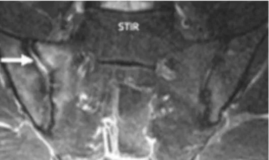 Figure 12. IRM des articulations sacro-iliaques en pondération STIR : épanchement  intra-articulaire à droite (Source : EULAR) 