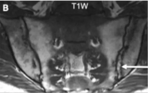 Figure 15. IRM des articulations sacro-iliaques en pondération STIR : backfill à gauche  [77] 