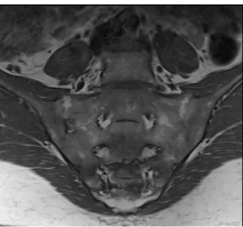 Figure 16. IRM des articulations sacro-iliaques en pondération T1 : ankylose bilatérale  (Source : EULAR) 